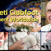Documentaire : Le traitement du pied bot par la méthode du Dr. Ponseti à travers le monde